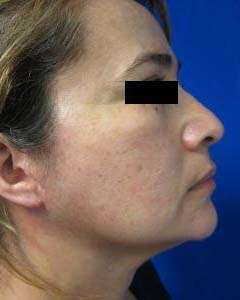 Neck Lift Before & After Patient #10052