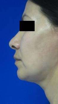 Neck Lift Before & After Patient #10060