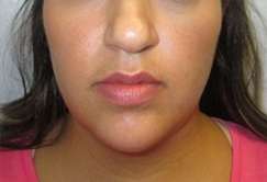 Neck Lift Before & After Patient #10063