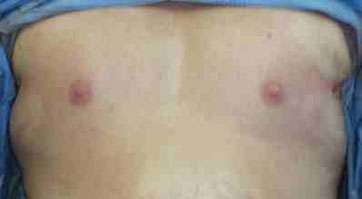 Pec Implants Before & After Patient #10068