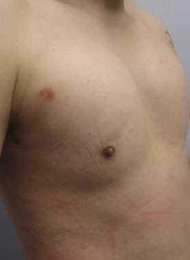 Pec Implants Before & After Patient #10073