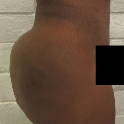 Brazilian Butt Lift Before & After Patient #6318