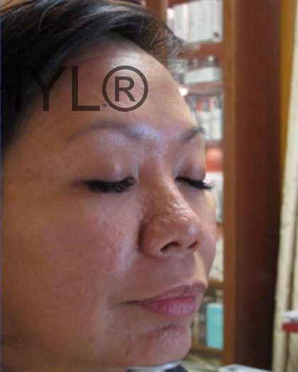 PRP for Facial Rejuvenation Before & After Patient #10081