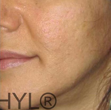 PRP for Facial Rejuvenation Before & After Patient #10084