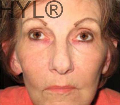 PRP for Facial Rejuvenation Before & After Patient #10090