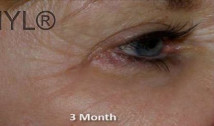 PRP for Facial Rejuvenation Before & After Patient #10093