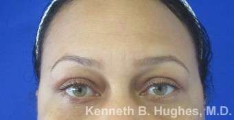 Rhinoplasty Before & After Patient #10096