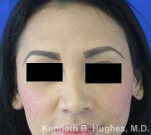 Rhinoplasty Before & After Patient #10099