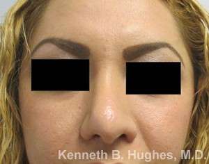 Rhinoplasty Before & After Patient #10102