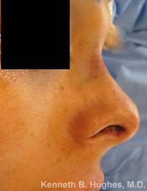 Rhinoplasty Before & After Patient #10105