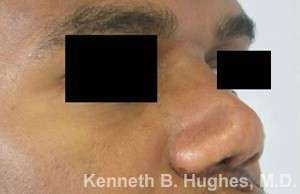 Rhinoplasty Before & After Patient #10110