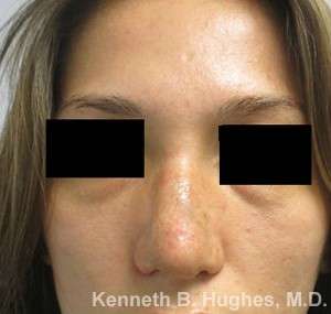 Rhinoplasty Before & After Patient #10113