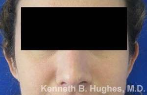 Rhinoplasty Before & After Patient #10116