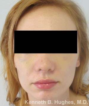 Rhinoplasty Before & After Patient #10119