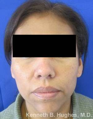 Rhinoplasty Before & After Patient #10122