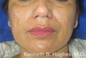 Rhinoplasty Before & After Patient #10125