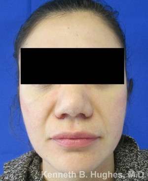 Rhinoplasty Before & After Patient #10128