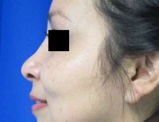 Rhinoplasty Before & After Patient #10131