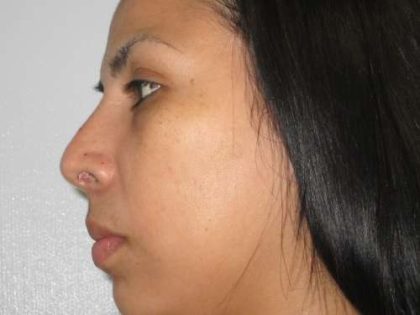 Rhinoplasty Before & After Patient #10137