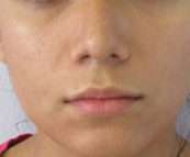Rhinoplasty Before & After Patient #10155