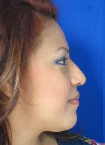 Rhinoplasty Before & After Patient #10158