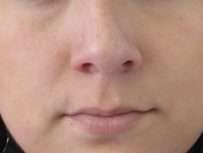 Rhinoplasty Before & After Patient #10161