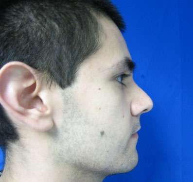 Rhinoplasty Before & After Patient #10164