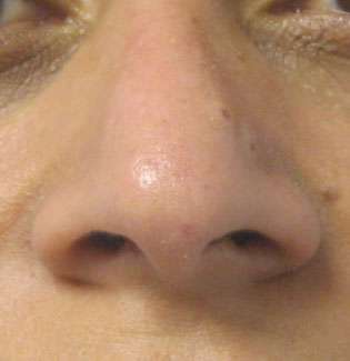 Rhinoplasty Before & After Patient #10175