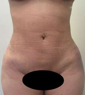 Liposuction Before & After Patient #6329