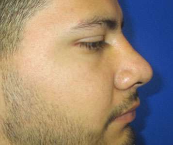 Rhinoplasty Before & After Patient #10183