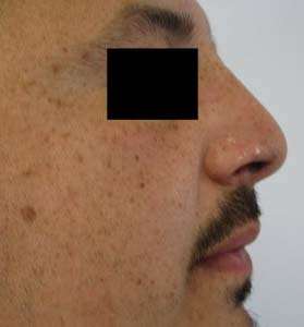 Rhinoplasty Before & After Patient #10188