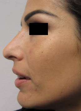 Rhinoplasty Before & After Patient #10191
