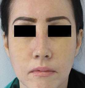 Rhinoplasty Before & After Patient #10196