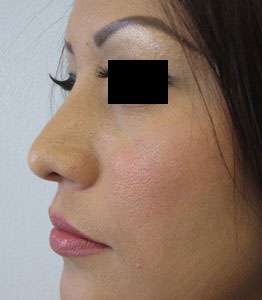 Rhinoplasty Before & After Patient #10201