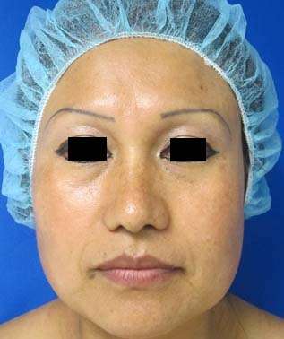 Rhinoplasty Before & After Patient #10204