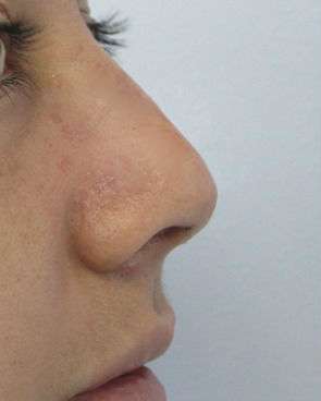 Rhinoplasty Before & After Patient #10207