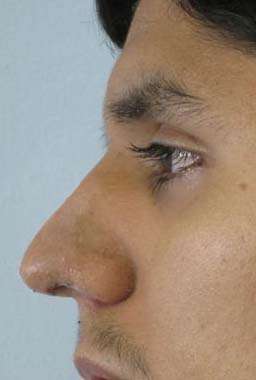 Rhinoplasty Before & After Patient #10210