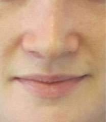 Rhinoplasty Before & After Patient #10213