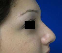 Rhinoplasty Before & After Patient #10216