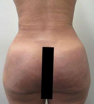 Brazilian Butt Lift Before & After Patient #6332