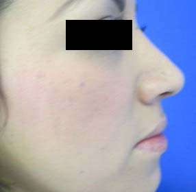 Rhinoplasty Before & After Patient #10225