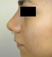 Rhinoplasty Before & After Patient #10228