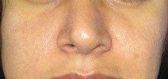 Rhinoplasty Before & After Patient #10234
