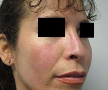 Rhinoplasty Before & After Patient #10239