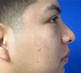 Rhinoplasty Before & After Patient #10242