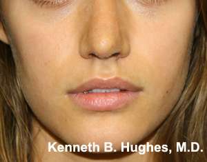Rhinoplasty Before & After Patient #10245