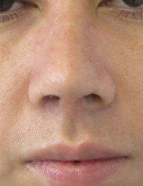 Rhinoplasty Before & After Patient #10253