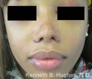 Rhinoplasty Before & After Patient #10256