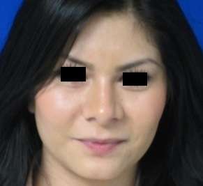 Rhinoplasty Before & After Patient #10261