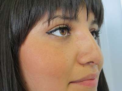 Rhinoplasty Before & After Patient #10264